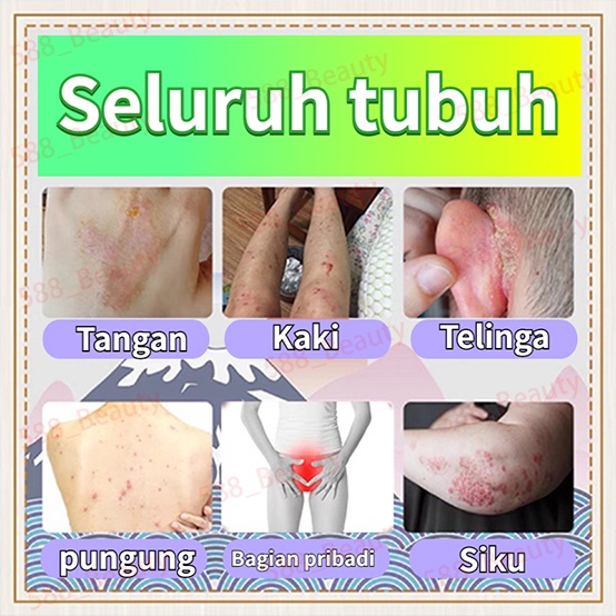 Salep gatal Salep eksim Salep kulit gatal Salep jamur kulit Obat salep gatal Obat salep psoriasis eczema cream salep gatal gatal