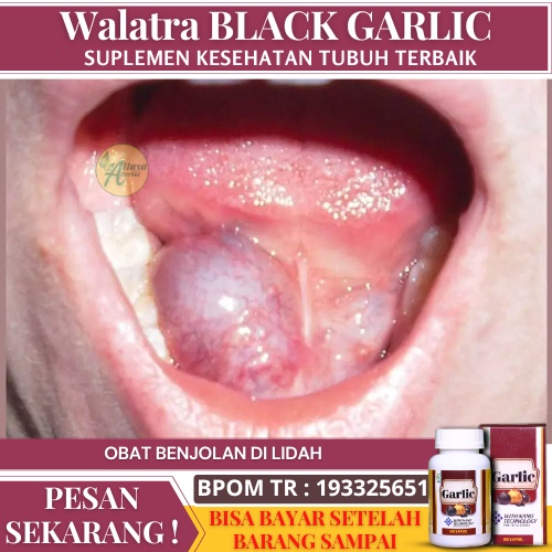 Obat Benjolan Lidah, Lidah Bengkak, Lidah Bernanah, Benjolan Di Bawah Lidah, Obat   Penghilang Benjo