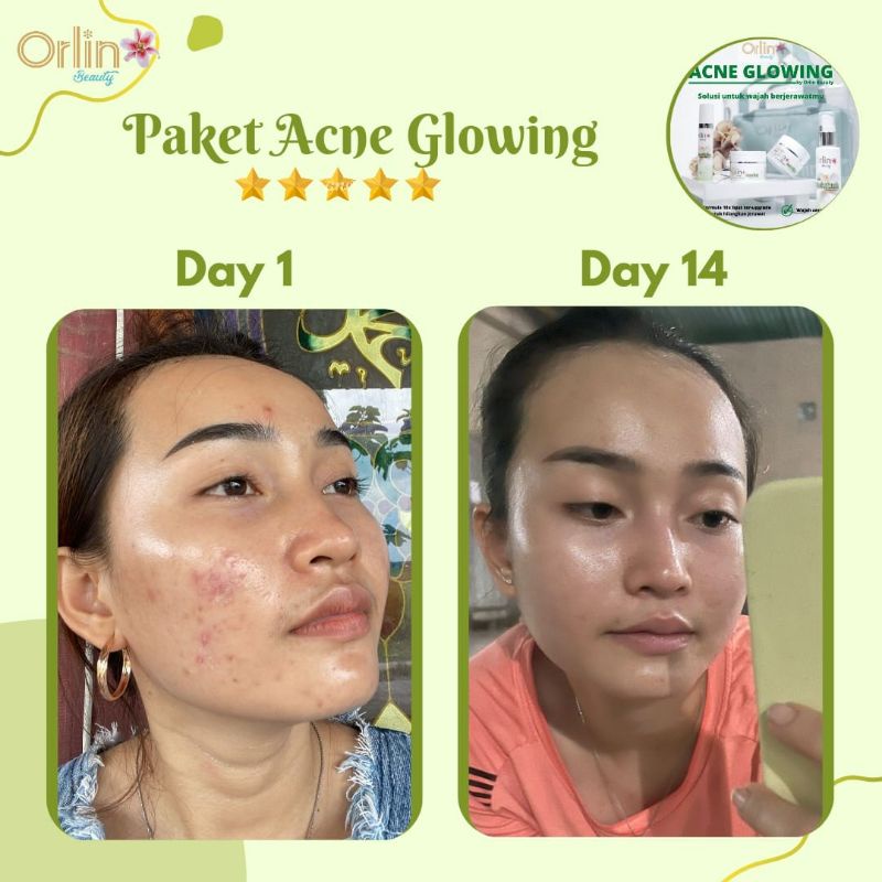 Miffglow - FREE GIFT Orlin beauty paket acne glowing orlin beauty paket acne platinum paket anti acne  original