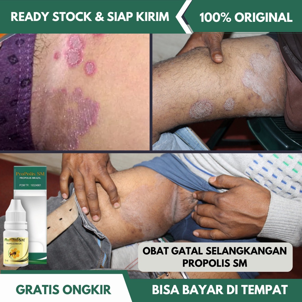 Obat Gatal Selangkangan, Obat Gatal Jamur Di Selangkangan, Sakit Gatal Di Selangkangan, Gatal Iritas