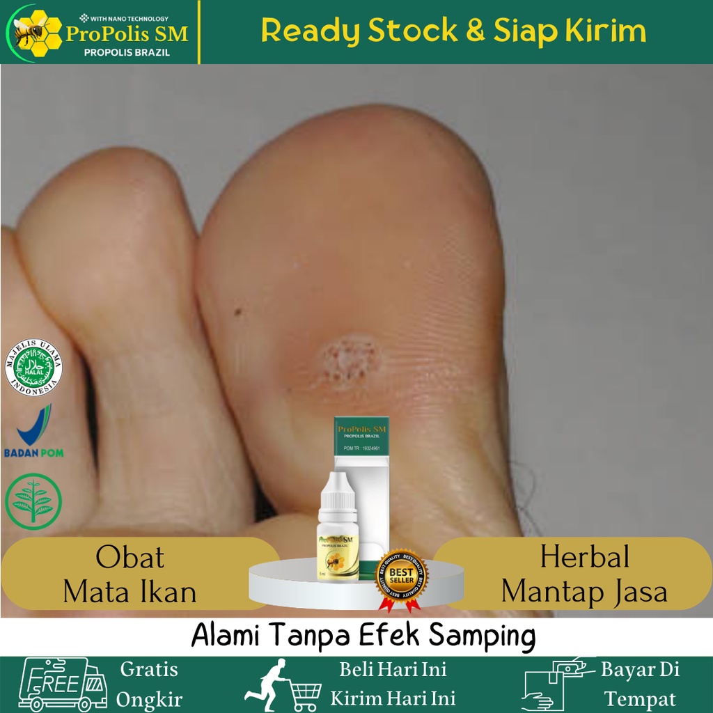 Obat Mata Ikan, Obat Perontok Mata Ikan, Obat Penghilang Mata Ikan, Obat Mata Ikan di Kaki, Obat Pen