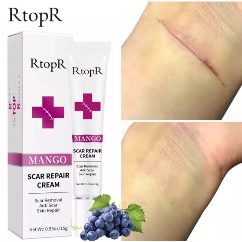 RtopR SCAR CREAM | KELO COTE SCAR CREAM PENGHILANG BEKAS LUKA