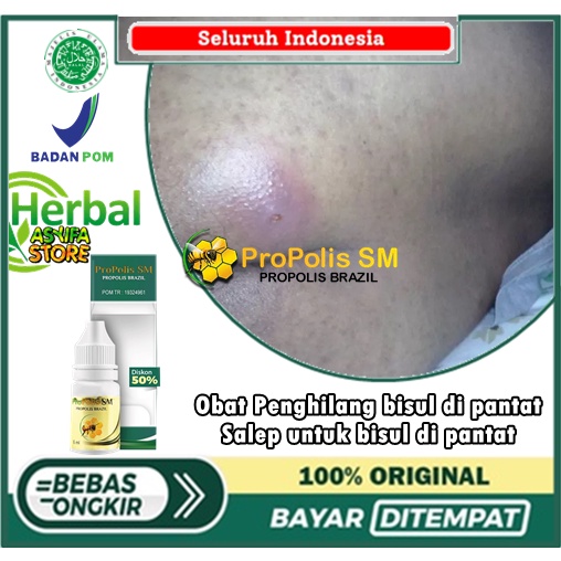 Obat Penghilang bisul di pantat, Salep untuk bisul di pantat, bisul pada pantat, udun di pantat, her