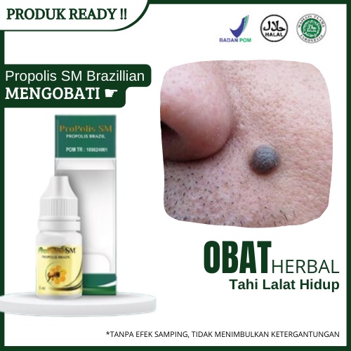 Obat Untuk Mematikan Tahi Lalat Hidup - Menghilangkan Benjolan Bintik Hitam Dengan Propolis SM