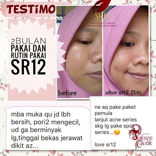 Acne Moist Cream SR12 Penghilang Jerawat dan Bekas Jerawat Obat Jerawat Melembabkan Kulit BPOM