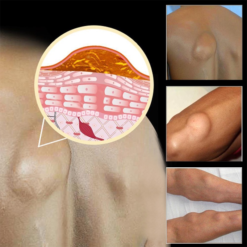 obat lipoma obat oles penghilang benjolan lipoma di tangan/Obat Kelenjar Getah Bening Obat Benjolan Di Leher Amandel Lipoma Serviks 30g