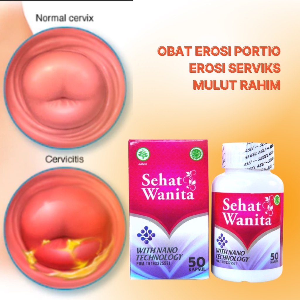 Jual Obat Erosi Portio, Erosi Serviks, Erosi Mulut Rahim, Infeksi Rahim ...