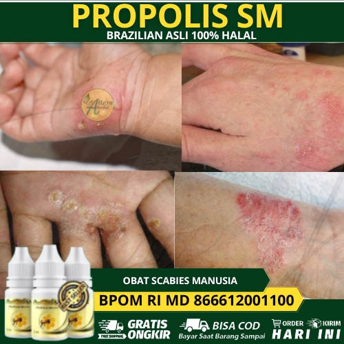 Obat Scabies Manusia, Gatal Kulit Skabies, Scabies Gatal, Pembasmi Kutu sekabies, Obat   Gatal Scabi