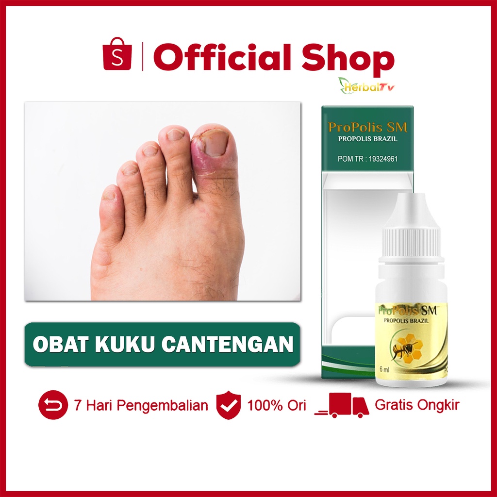 Obat Kuku Cantengan Bengkak Bernanah Kuku Jempol Kaki Bengkak Bau - Propolis SM