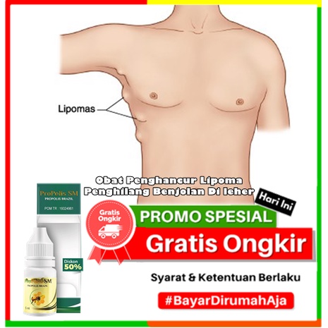 Obat Penghancur Lipoma, Penghilang Benjolan Di leher, Penghancur Lipoma di apotik, Obat Penghancur B