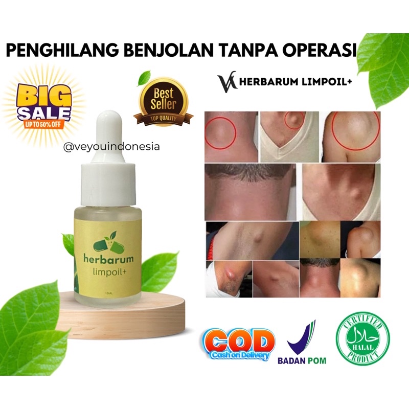 Jual Hari Benjolan Kempes Herbarum Limpoil Obat Benjolan Tanpa