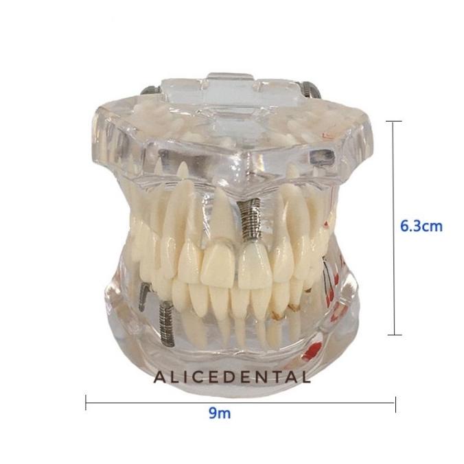 Model studi gigi implant crown bridge bening transparan phantom dental ---TERBARU---