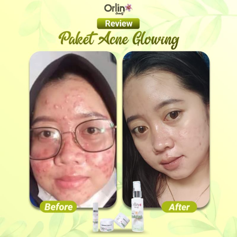 Miffglow - FREE GIFT Orlin beauty paket acne glowing orlin beauty paket acne platinum paket anti acne  original