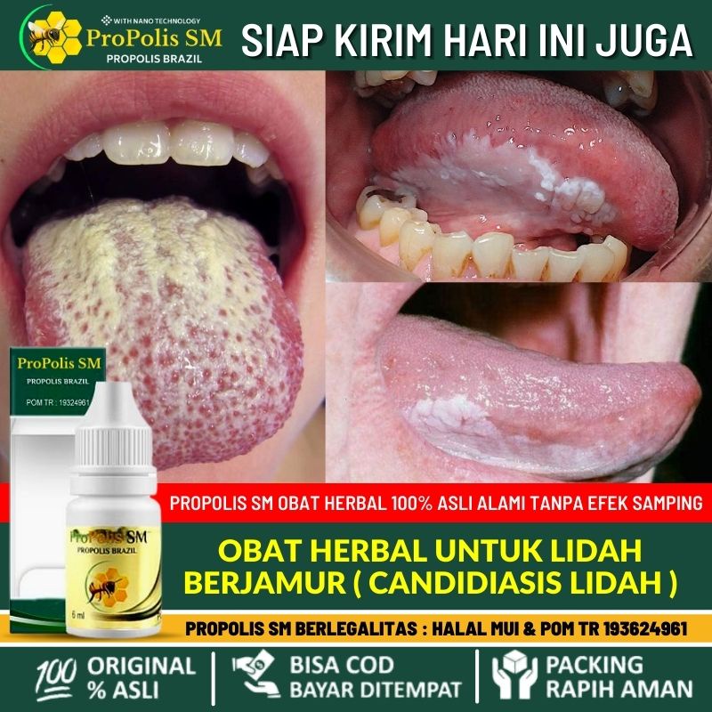 Obat Tetes Alami Pembersih Lidah Berjamur, Obat Kandidiasis Oral, Obat Infeksi Jamur di Mulut, Obat 