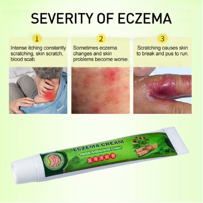 【ORIGINAL】Salep gatal Salep Eksim Salep kulit Krim psoriasis paling ampuh 20g Kulit Kepala Psoriasis Tangan Tinea Kaki Bau Versicolor Menghambat Dermatitis Jamur Anti Gatal Cream