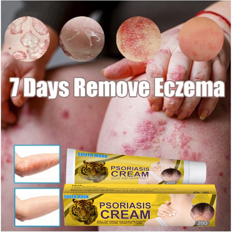 Krim Gatal Salep Gatal  Salep Kulit Salep Krim Obat Herbal Cina Alami Eksim Krim Psoriasis Paling Am