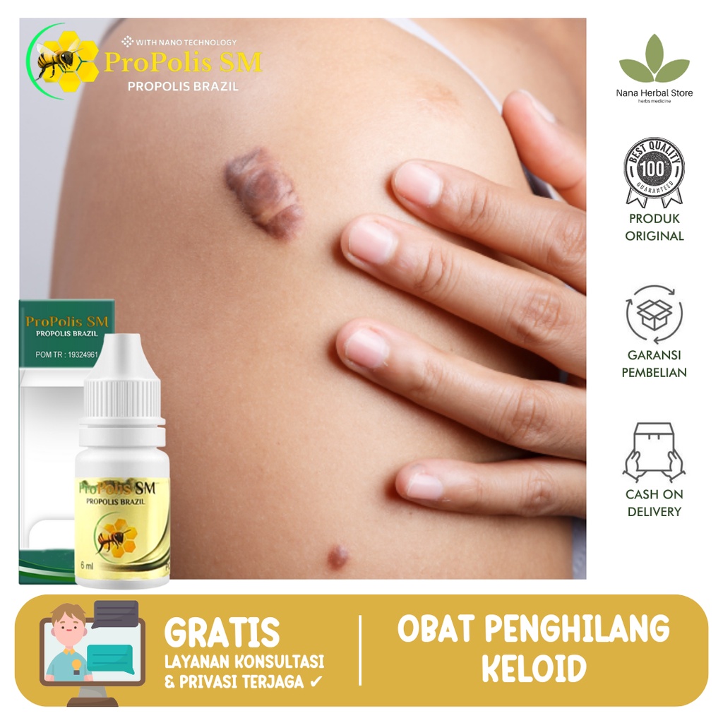 Obat Oles Keloid Menahun, Obat Penghilang Keloid Yang Sudah Lama, Keloid Bekas Injeksi, Obat Keloid 
