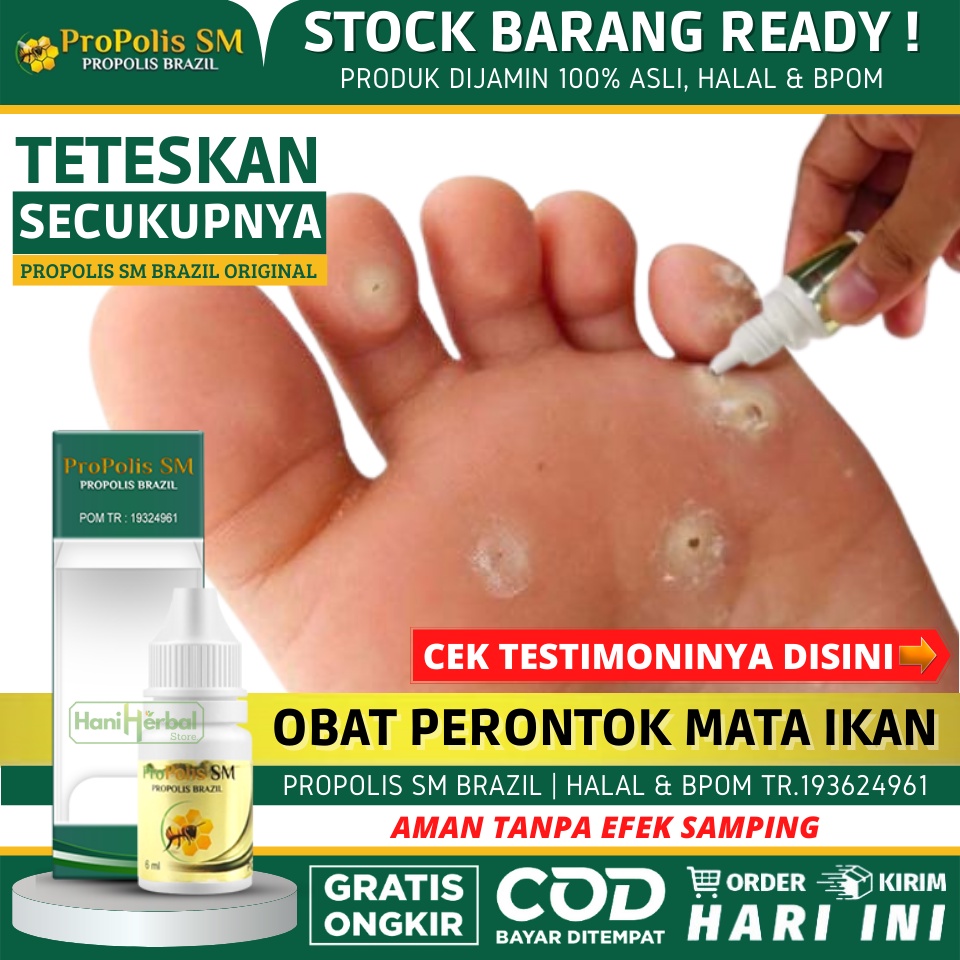 Obat Perontok Mata Ikan, Obat Mata Ikan di Telapak Kaki, Obat Kapalan di Kaki & Tangan, Obat Kaki Ra