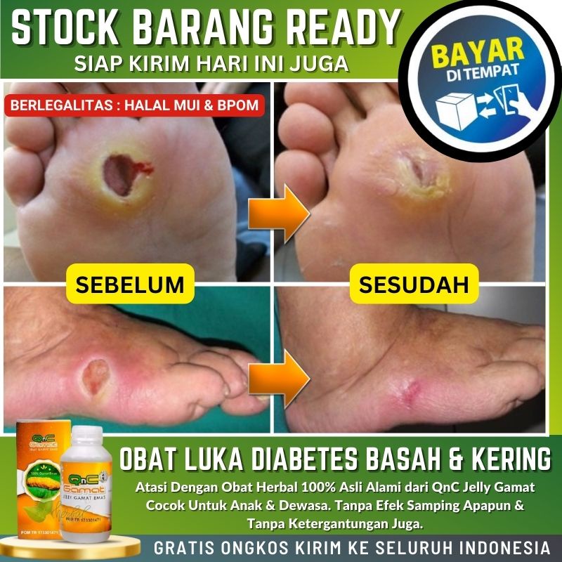 Obat Luka Diabetes Basah & Kering, Obat Oles Luka Diabetes di Kaki, Obat Kaki Baal, Kaki Mati Rasa, 