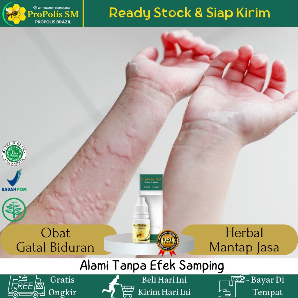Obat Gatal Biduran, Obat Gatal Ruam Merah, Obat Biduran, Obat Herbal Biduran, Obat Gatal Biduran Ana