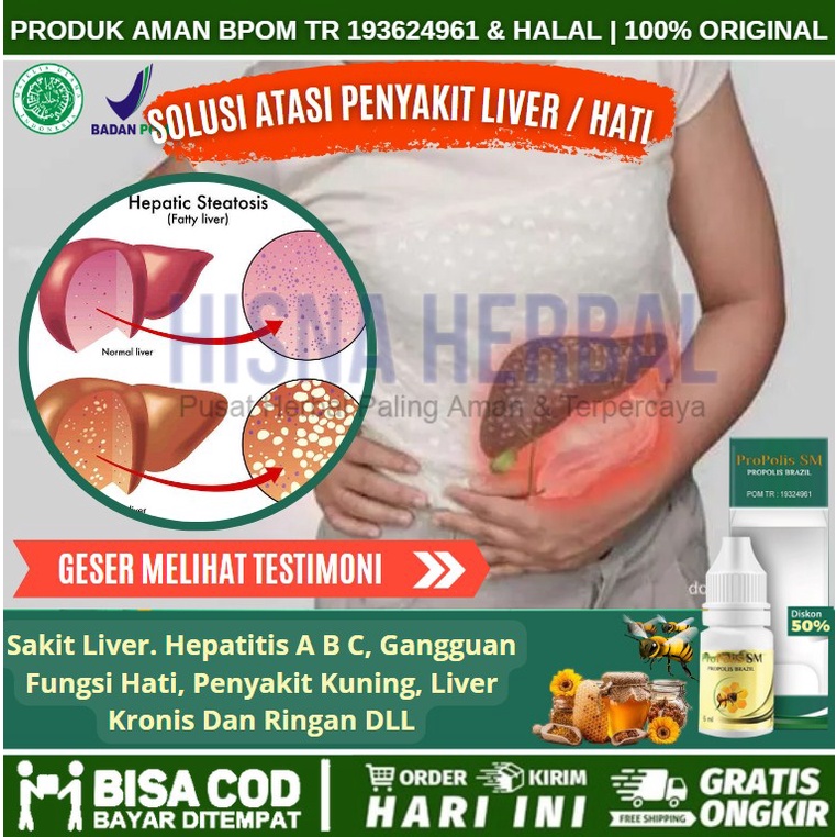 Obat Liver Perut Bengkak, Kaki Bengkak, Sakit Sesak, Obat Liver Kronis Dan Ringan, Penyakit Kuning, 