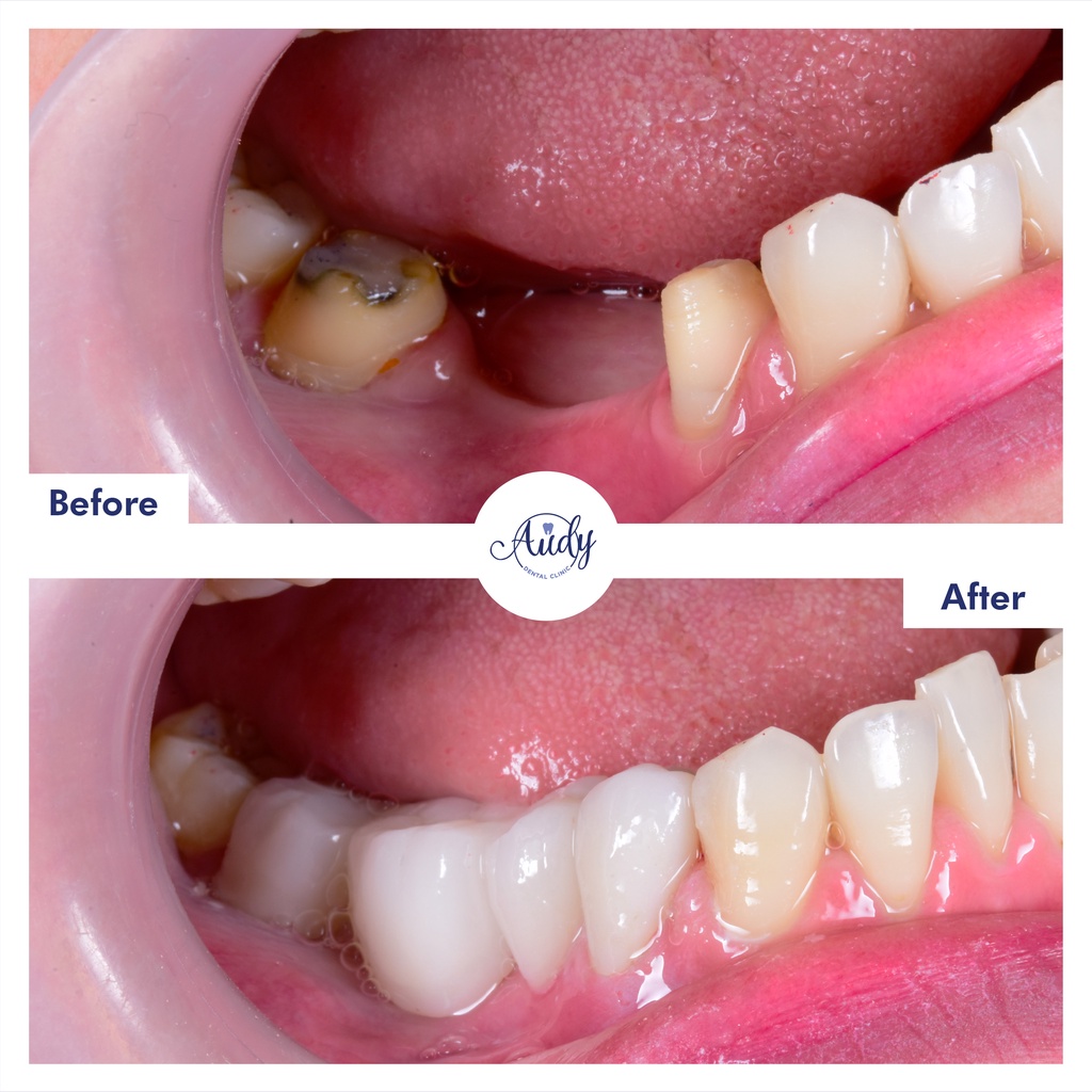 2 PCS KUAT PERMANEN | Pengganti Gigi Ompong Penambal Gigi Berlubang 100% ORIGINAL Temptooth temporar