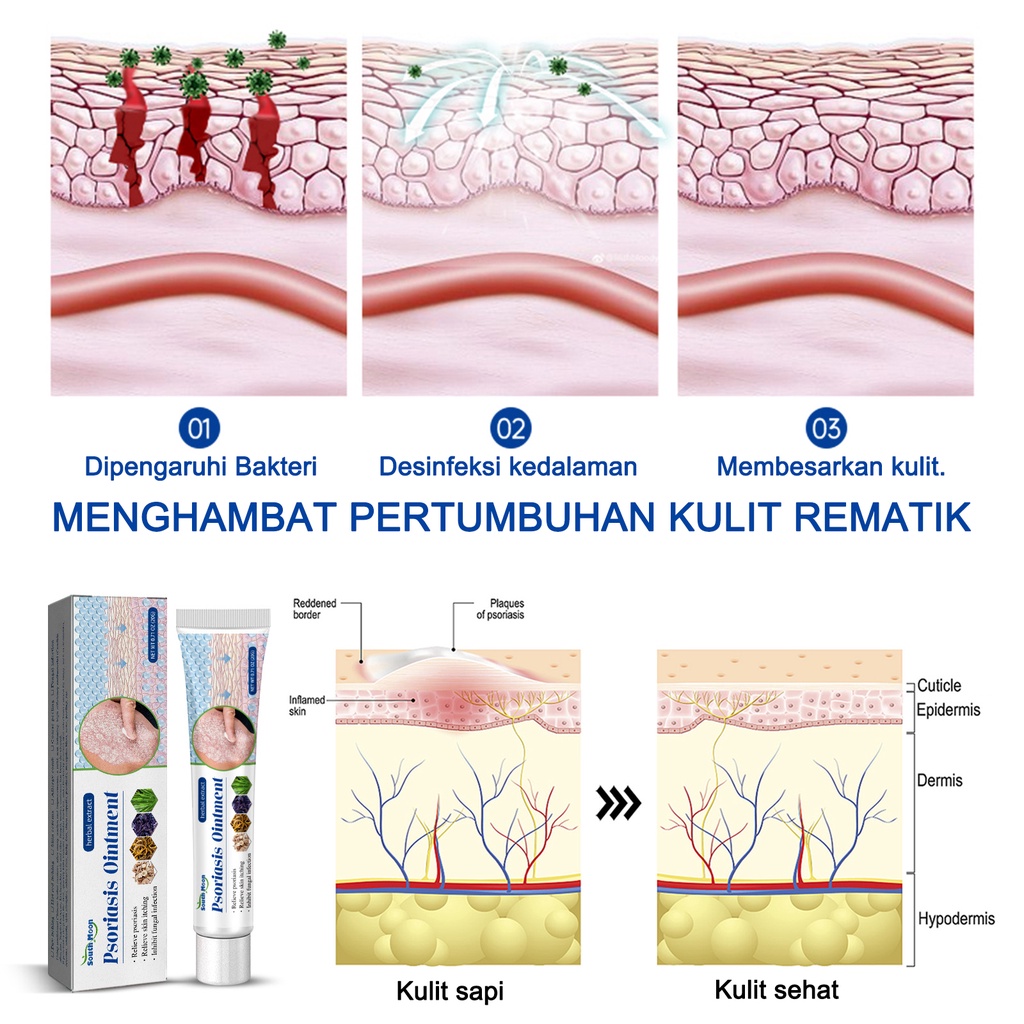 【100% ORIGINAL】[BPOM&amp;COD]Salep gatal Salep Eksim Salep kulit Krim psoriasis paling ampuh Kulit Kepala Psoriasis Tangan Tinea Kaki Bau Versicolor Menghambat