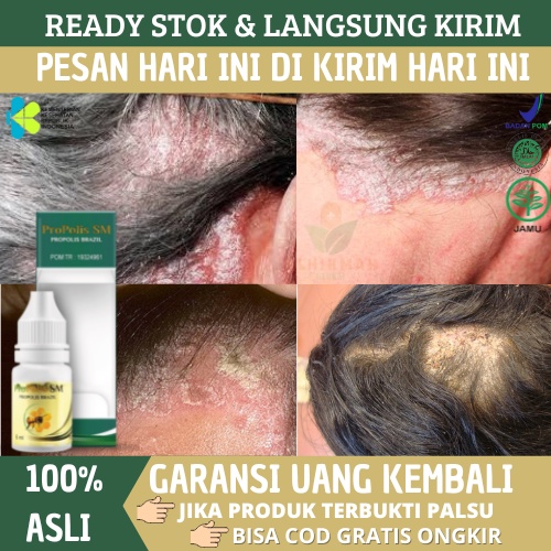 Obat Kulit Kepala Berkerak, Ketombe Parah Berkerak, Obat Psoriasis di Kulit Kepala, Borok Kulit Kepa