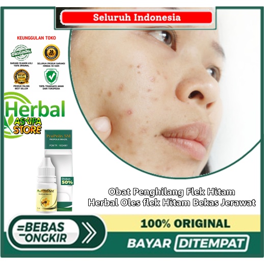 Obat Penghilang Flek Hitam, Herbal Oles flek Hitam Bekas Jerawat, Salep Penghilang Flek Hitam, Pengh