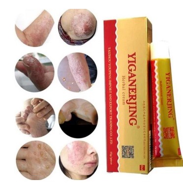Obat YIGANERJING Salep Herbal Cream Eksim, Gatel-Gatal Kuli,t Jamur