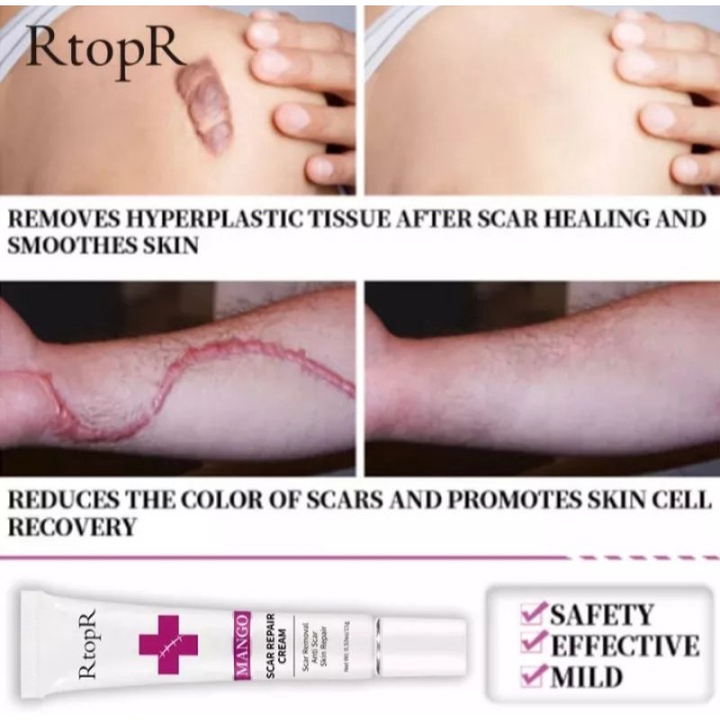 RtopR SCAR CREAM | KELO COTE SCAR CREAM PENGHILANG BEKAS LUKA