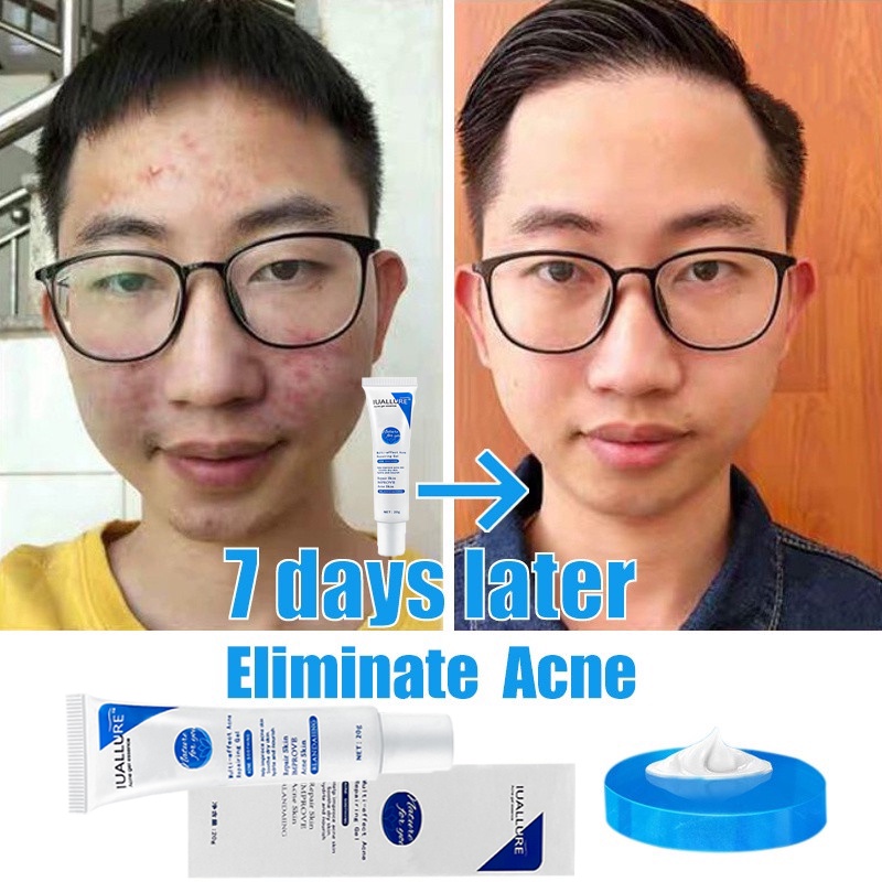 cream jerawat obat totol jerawat krim jerawat obat jerawat dan bekas jerawat Jerawat Removal of Acne Cream Untuk Pria dan Wanita Menghilangkan jerawat dengan cepat