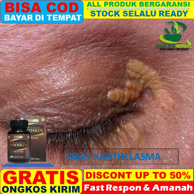 Jual Obat Xanthelasma Obat Untuk Menghilangkan Xanthelasma, Obat ...