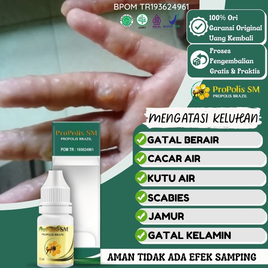 Jual Obat Gatal Berair Di Jari Tangan Dan Kaki Kutu Air Bintik Bintik