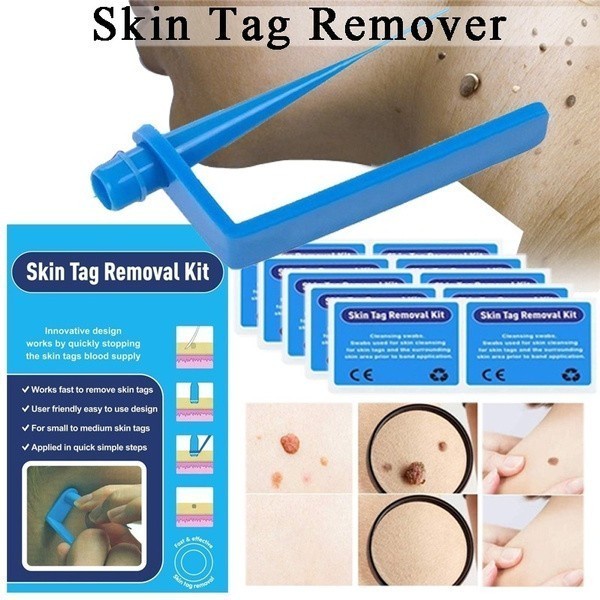 barokah gamis Auto Micro Skin Tag Remover Alat Penghilang Kutil Painless Removal Kit