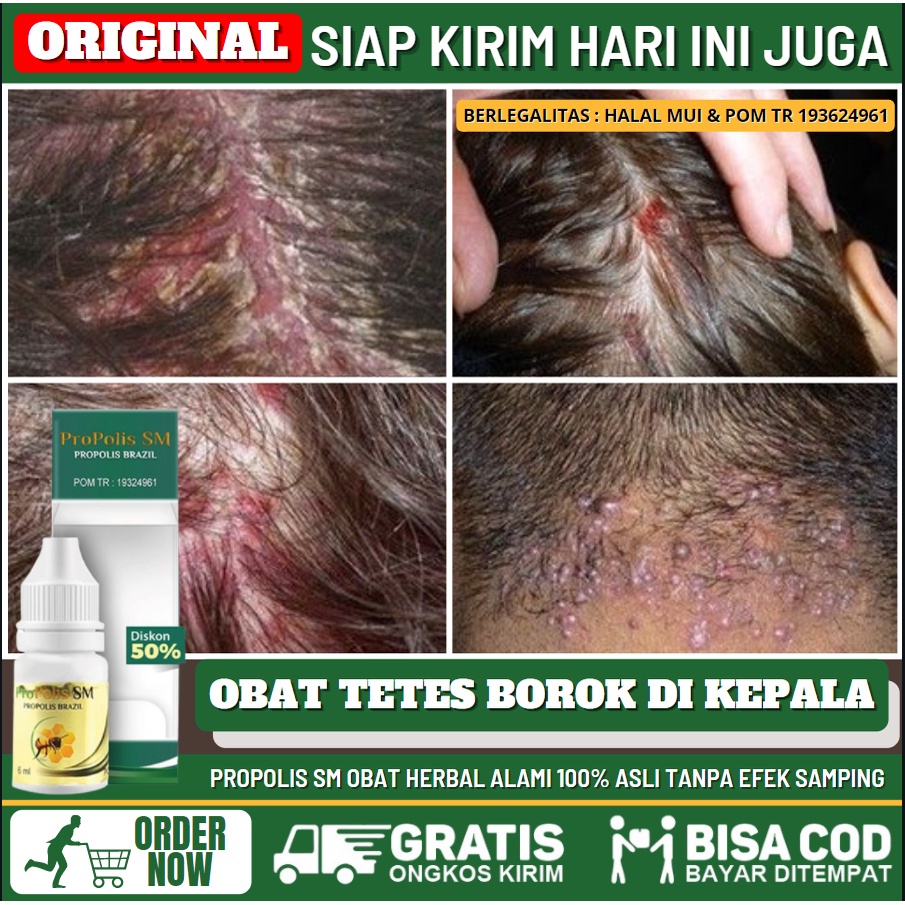 Obat Borok Berdarah di Kulit Kepala, Salep Herbal Borok Bernanah di Kulit Kepala, Obat Ketombe Berke
