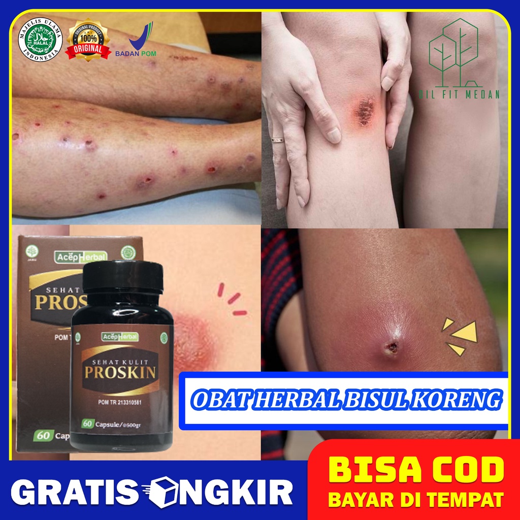 Obat Gatal Selangkangan Eksim kurap Selangkangan Salep Infeksi Jamur Bisul Gatal Tinea Cruris