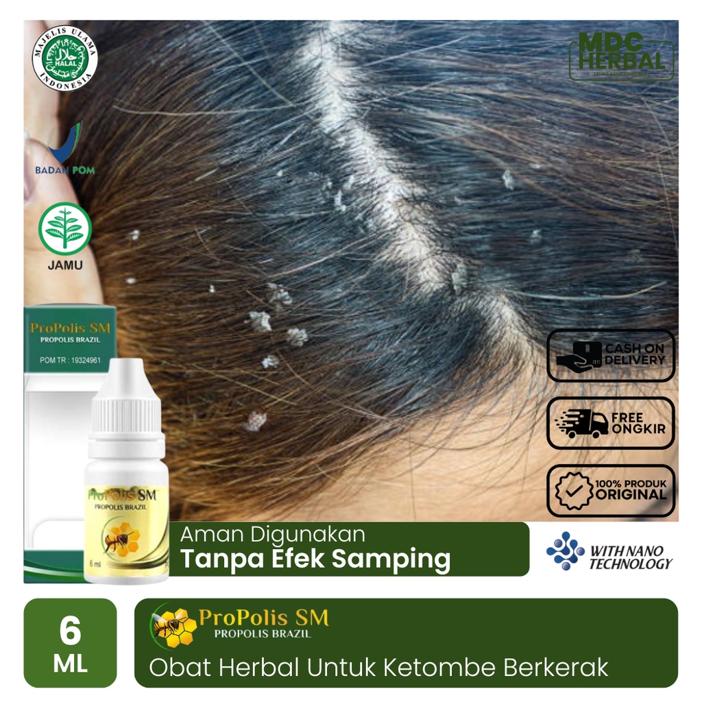 Jual Obat Ketombe Berkerak di Kepala, Obat Tetes Ketombe Parah, Kulit