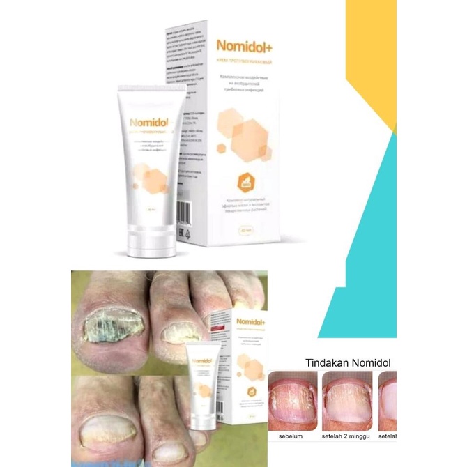 Krim Obat Kuku Kaki Cantengan Bau Bernanah Kuku Hitam Rusak Berjamur