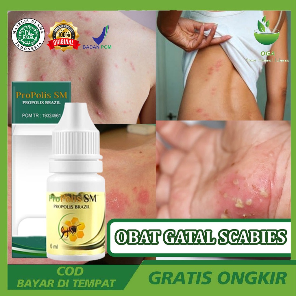 Propolis Anti Gatel Salep Kurap Panu Scabis Original