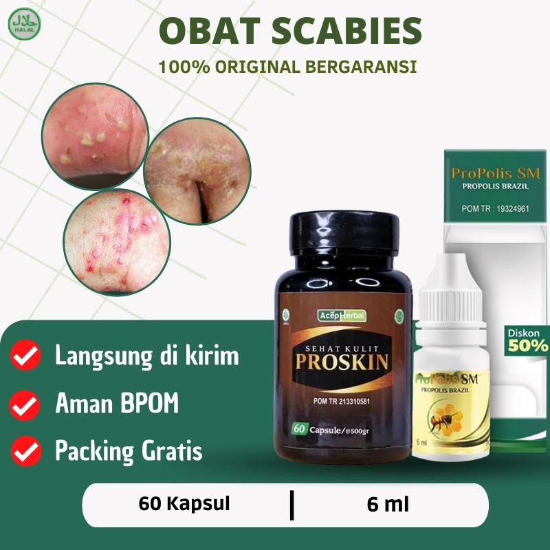 Proskin - Obat Scabies, Obat Scabies Manusia, Salep Scabies untuk manusia, Obat Scabies Kudis kurap 