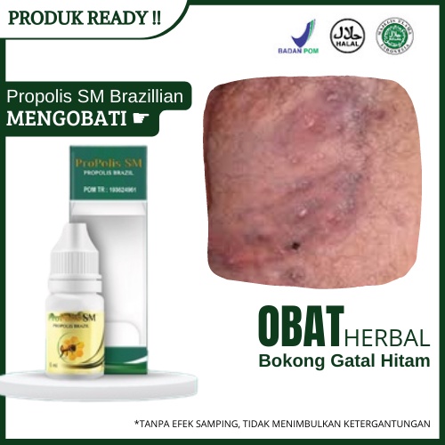 Obat Bokong Gatal Hitam, Obat Ruam Di Bokong, Menghilangkan Benjolan Kecil Merah, Obat Luka Di Anus,