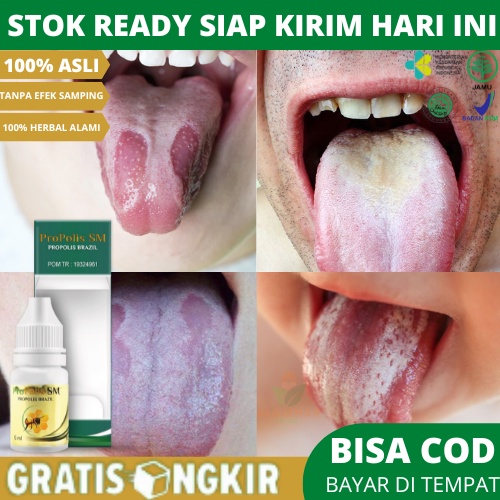 Obat Lidah Pecah Pecah, Obat Sariawan Di Lidah, Obat Tetes Lidah Pecah Pecah, Obat Lidah Putih Pecah
