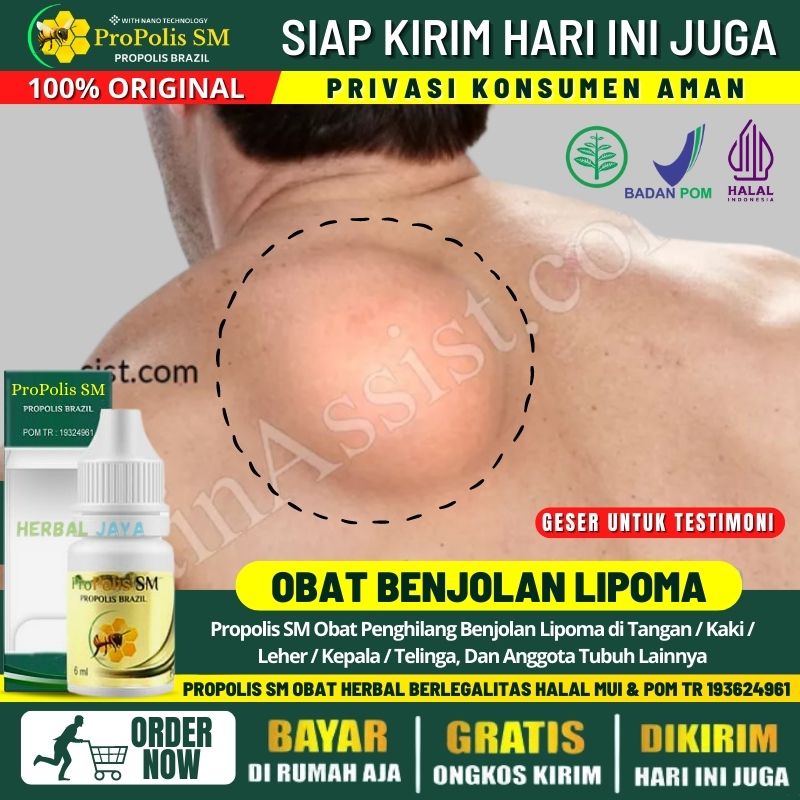 Obat Oles Penghilang Lipoma di Punggung / Leher / Kepala / DLL, Obat Herbal Lipoma, Penghancur Benjo