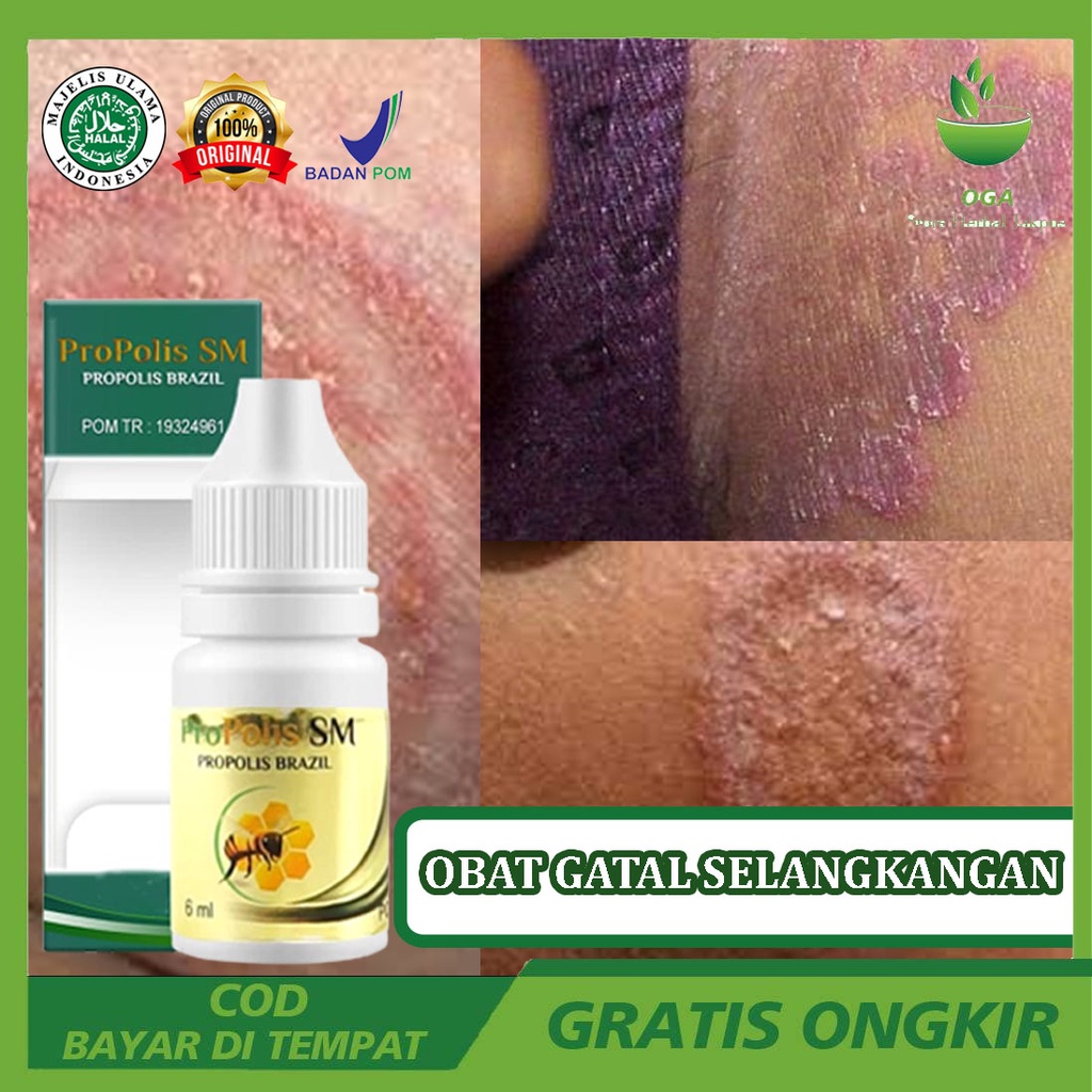 Obat Jamur Selangkangan Gatal Perih Hitam Berjamur Ruam Merah Gatal-Gatal Menahun Dengan Propolis sm