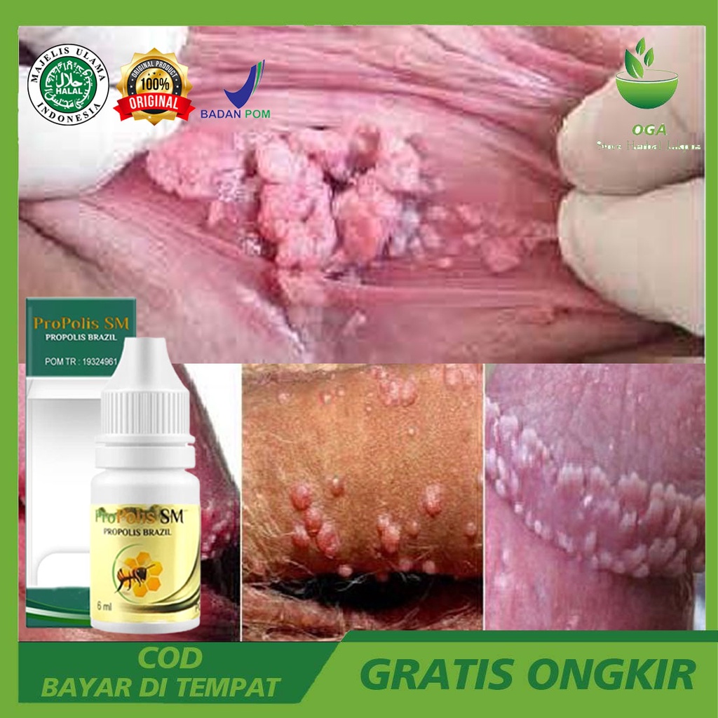 Obat Penghilang Kutil Kelamin, Merontokan Kutil Kelamin, Perontok Kutil Kelamin, Penghancur Kutil Ke