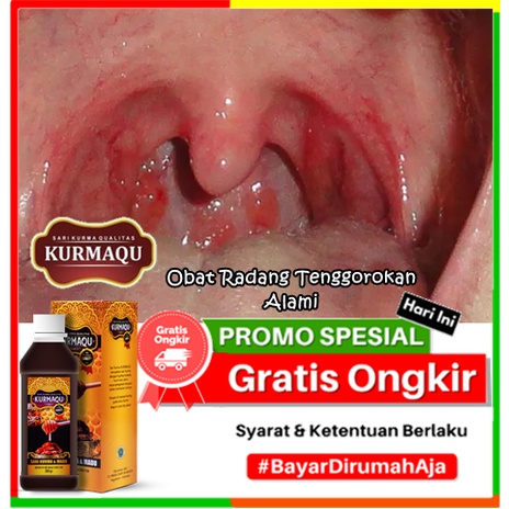 Jual Obat Radang Tenggorokan Alami | Penghilang Radang Amandel, Amandel ...