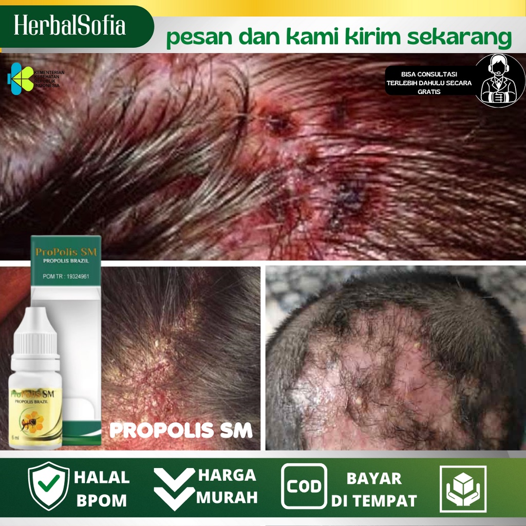 Obat Borok di Kepala, Penghilang Borok di Kulit Kepala, Psoriasis Kulit Kepala, Salep Kulit Kepala B