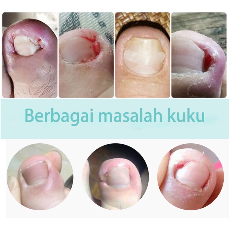 Krim perbaikan kuku Aman tidak sakit/Perawtan kuku Anti virus Mengatasi gatal Serum menghilangkan onokomikosis/Krim kuku jamur Krim perbaikan memperbaiki kuku jamur