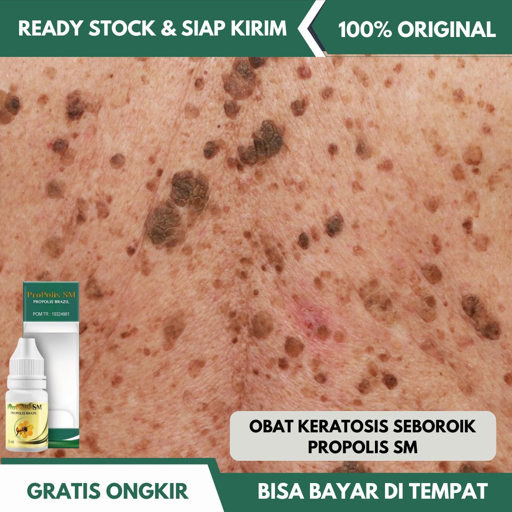 Jual Obat Keratosis Seboroik Penyakit Kulit Bintik Hitam Di Kulit Benjolan Kecil Kecokelatan